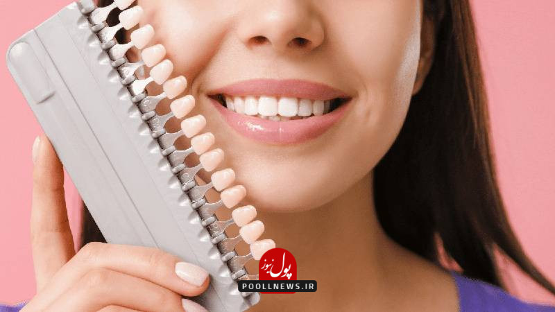 مزایای استفاده از composite veneer چیست؟