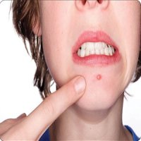 دردسر دیگر کرونا آکنه‌های ماسکی!