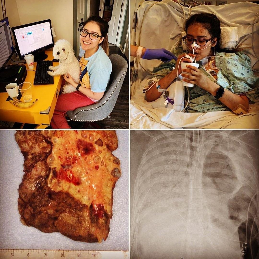 ریه فاسد شده بیمار کرونایی +عکس (+۱۶)