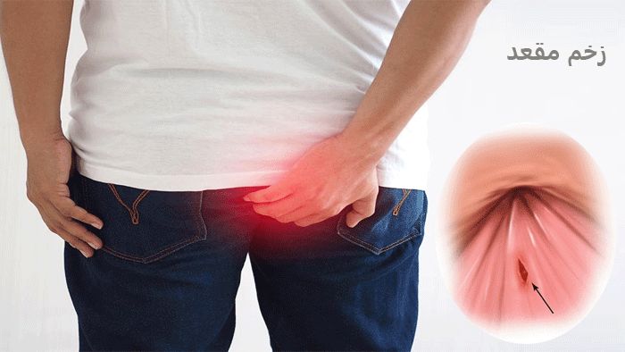 چرا دچار زخم مقعد می‌شویم؟
