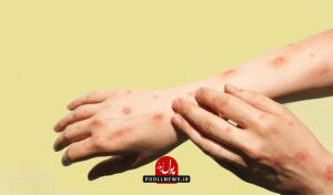 آبله میمونی