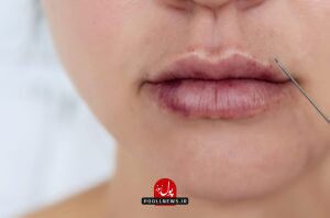 رفع کبودی لب بعد از تزریق ژل