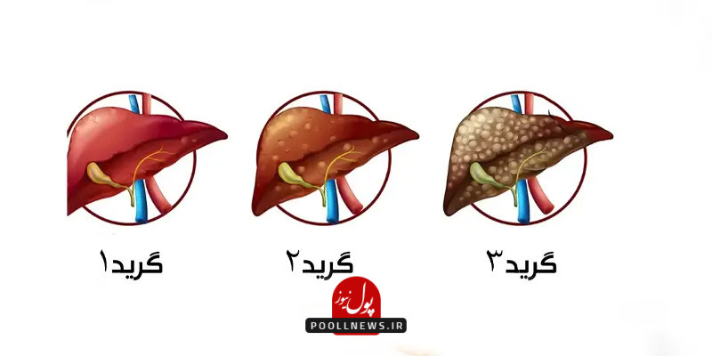 عوارض گردو برای کبد چرب