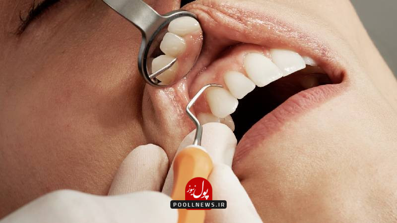 قیمت کامپوزیت دندان چگونه تعیین می‌شود؟